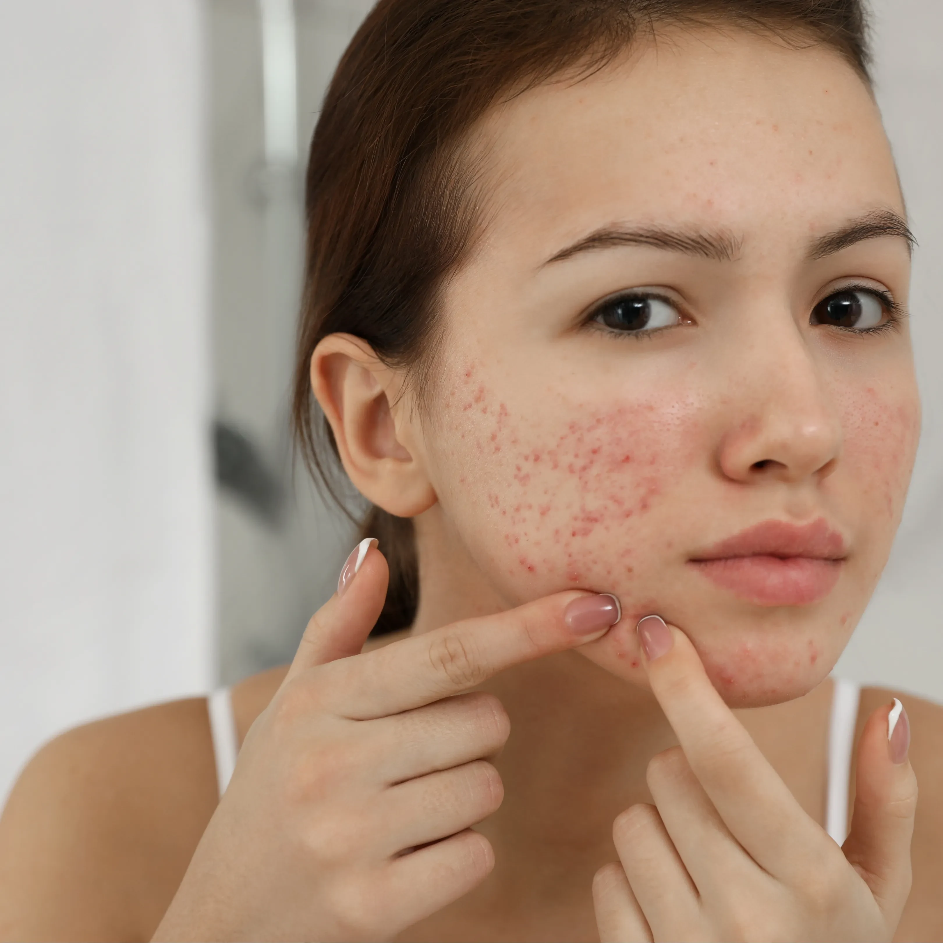 Acne Control and Skin Repair Protocol